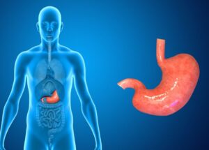 Αδενοκαρκίνωμα Στομάχου